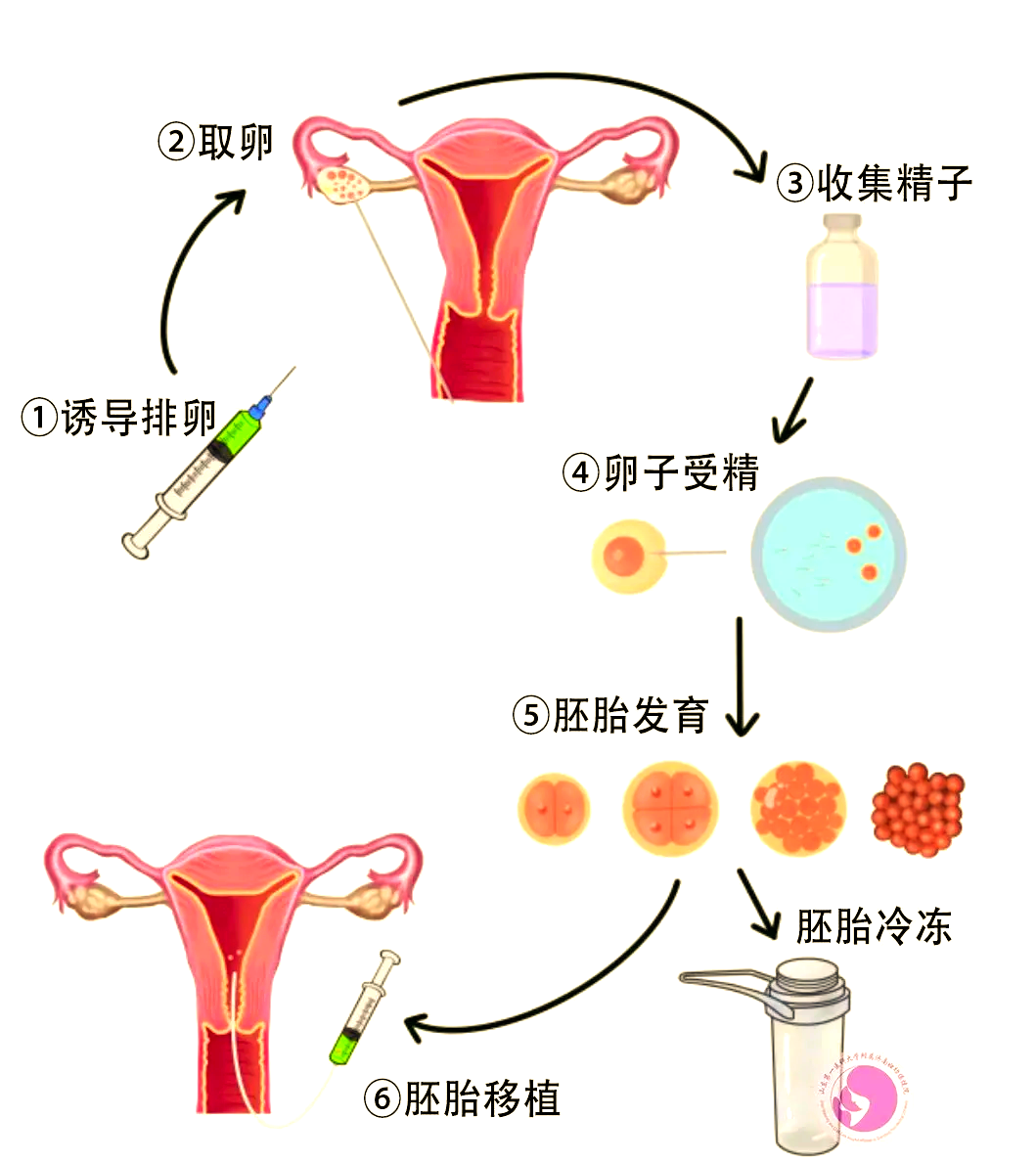 一代试管如何能生个儿子