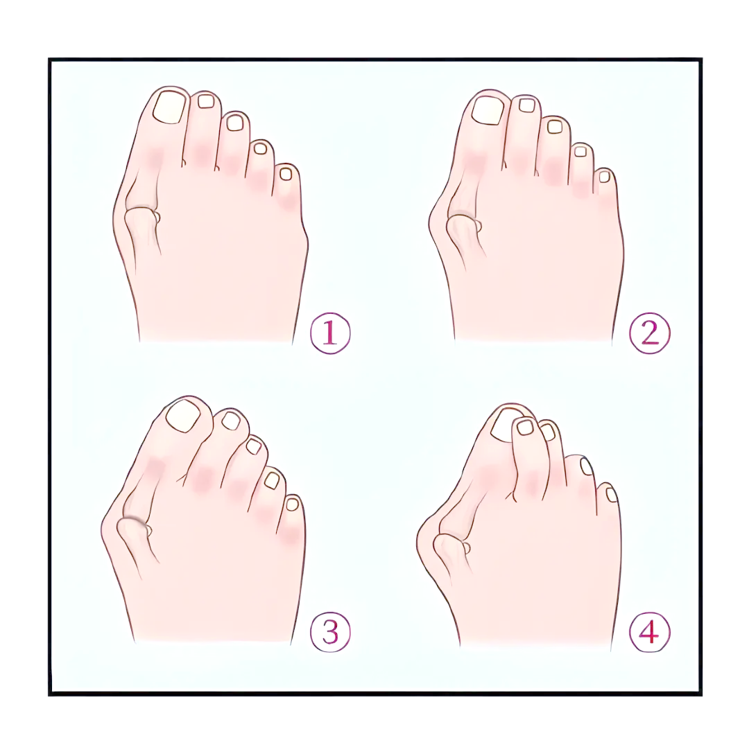 为什么会得拇外翻 为什么会得拇外翻