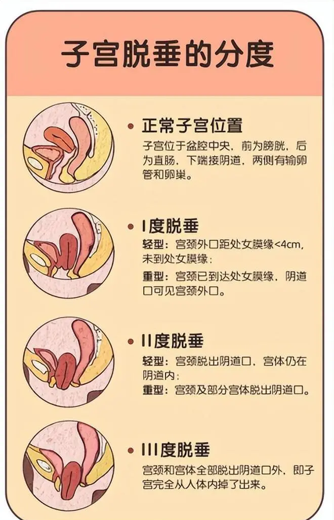 为什么子宫会下垂