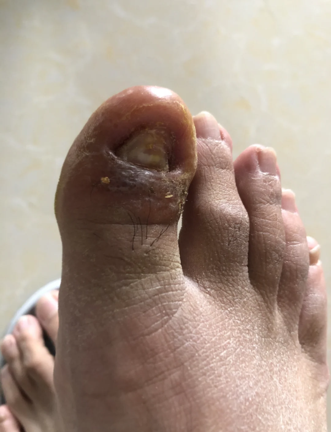修脚传染艾滋病案例