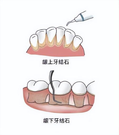 牙周病刮治的流程图片图片