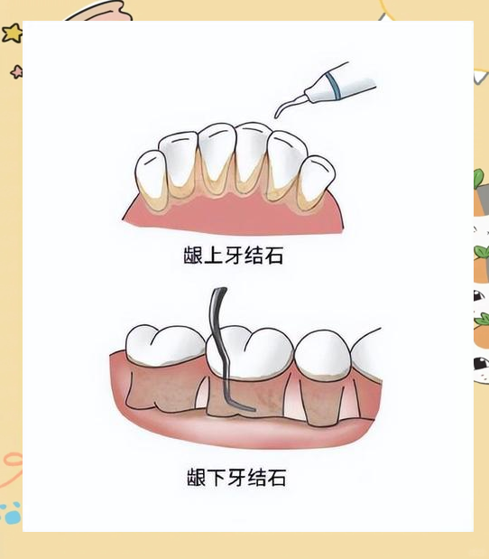 龈下刮治非常痛苦图片