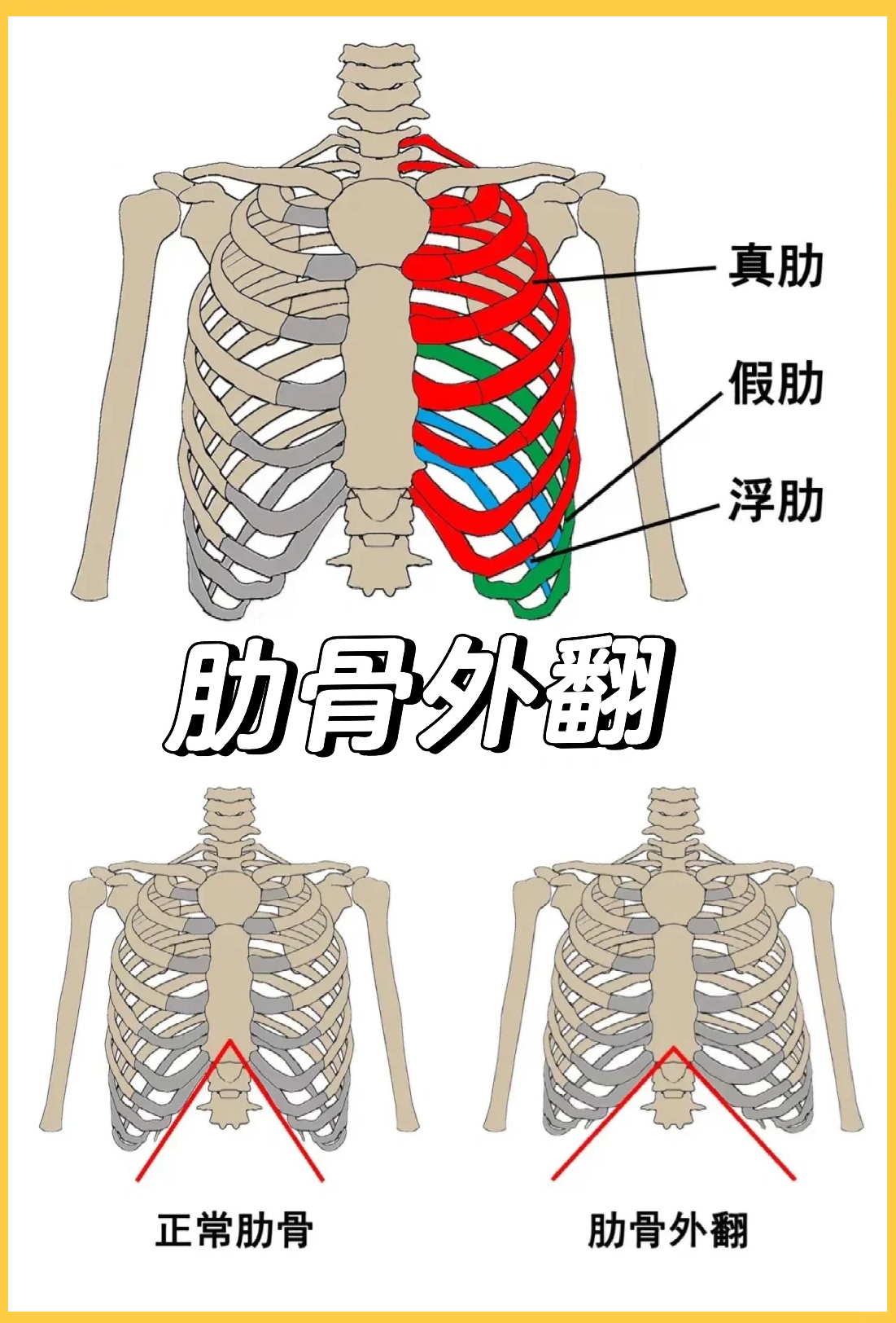 人体肋骨外翻图片