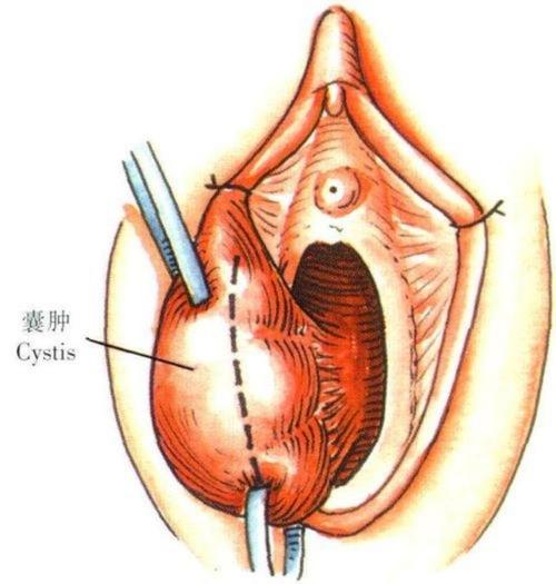 前庭大腺肿大图片