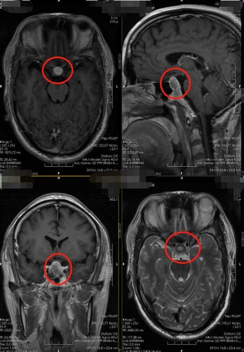 垂体瘤长在哪里图片图片
