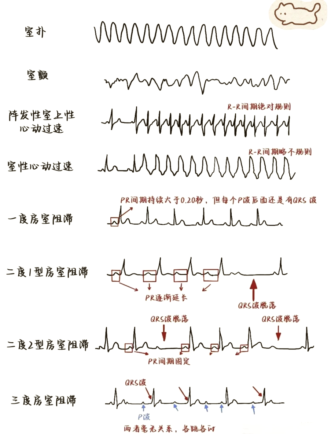 室颤与室扑心电图特点图片