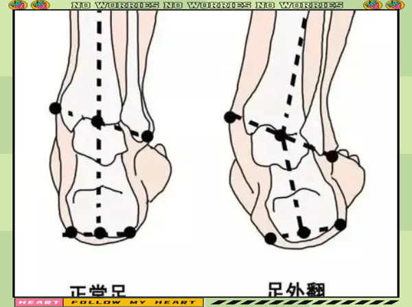 宝宝足外翻有什么影响图片