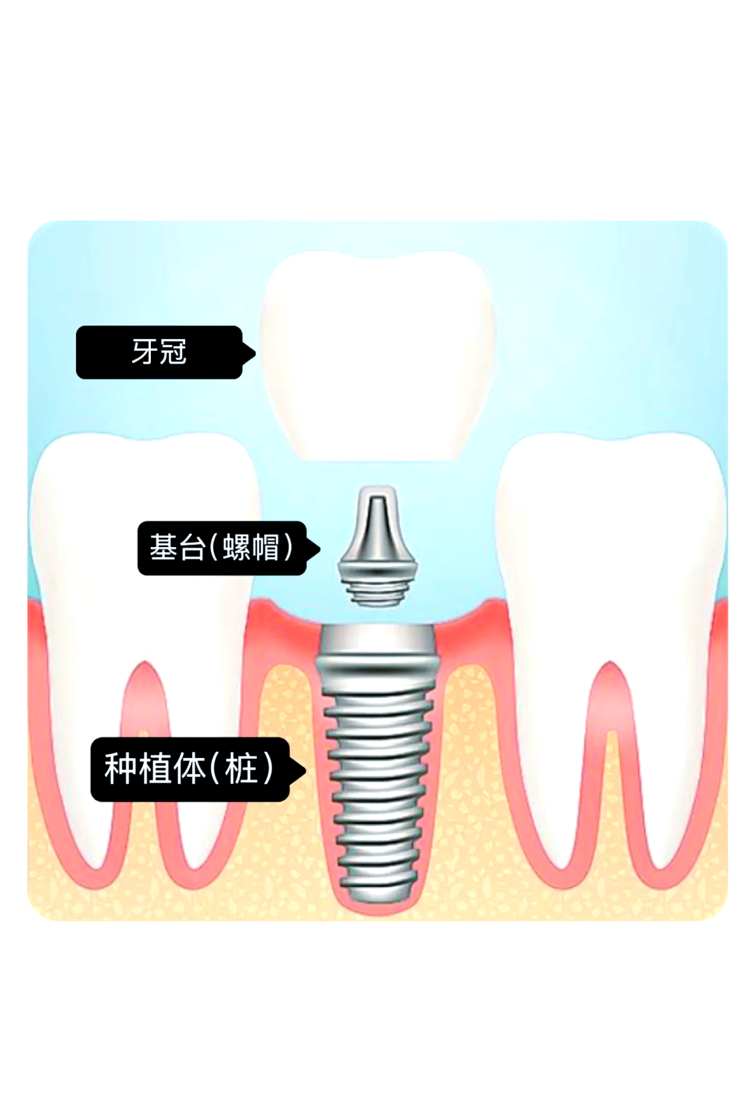 种植牙全解析,终于搞清楚了!