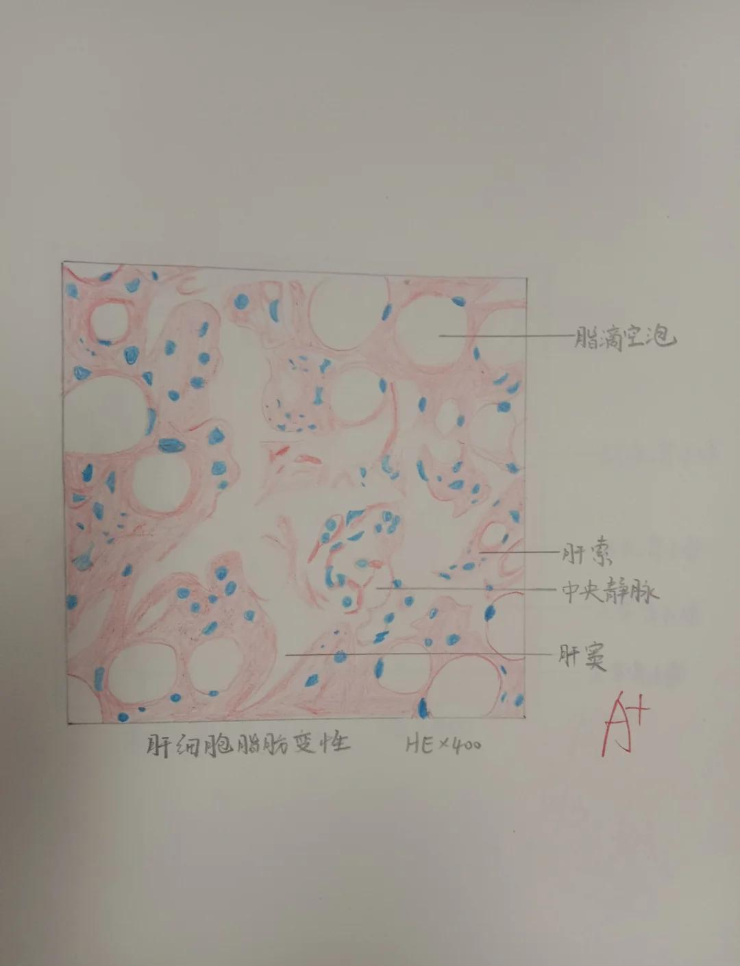 肠伤寒红蓝铅笔图图片