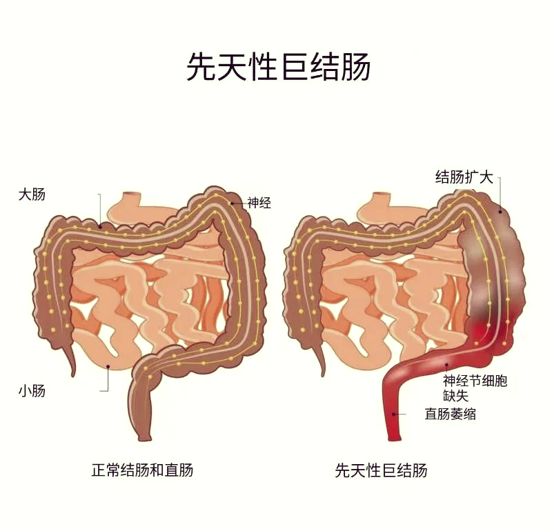 巨结肠的大便图示图片