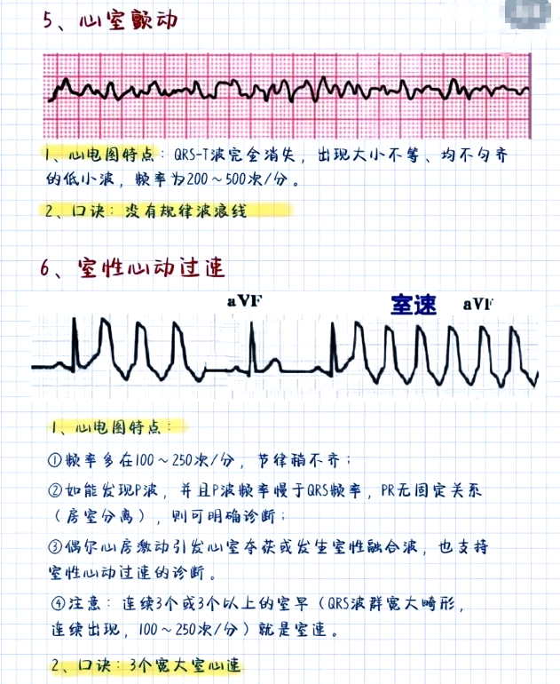 短阵房速心电图特点图片