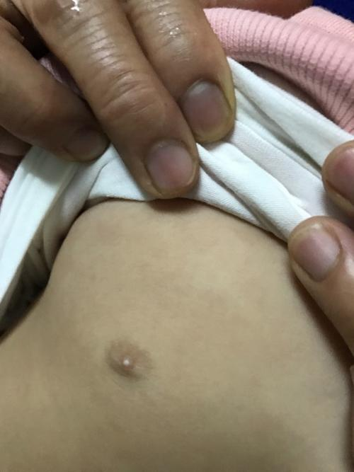 👶宝宝乳头小白点?这些情况你了解吗?