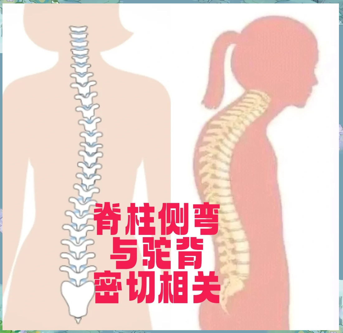 弓背和驼背的区别图图片