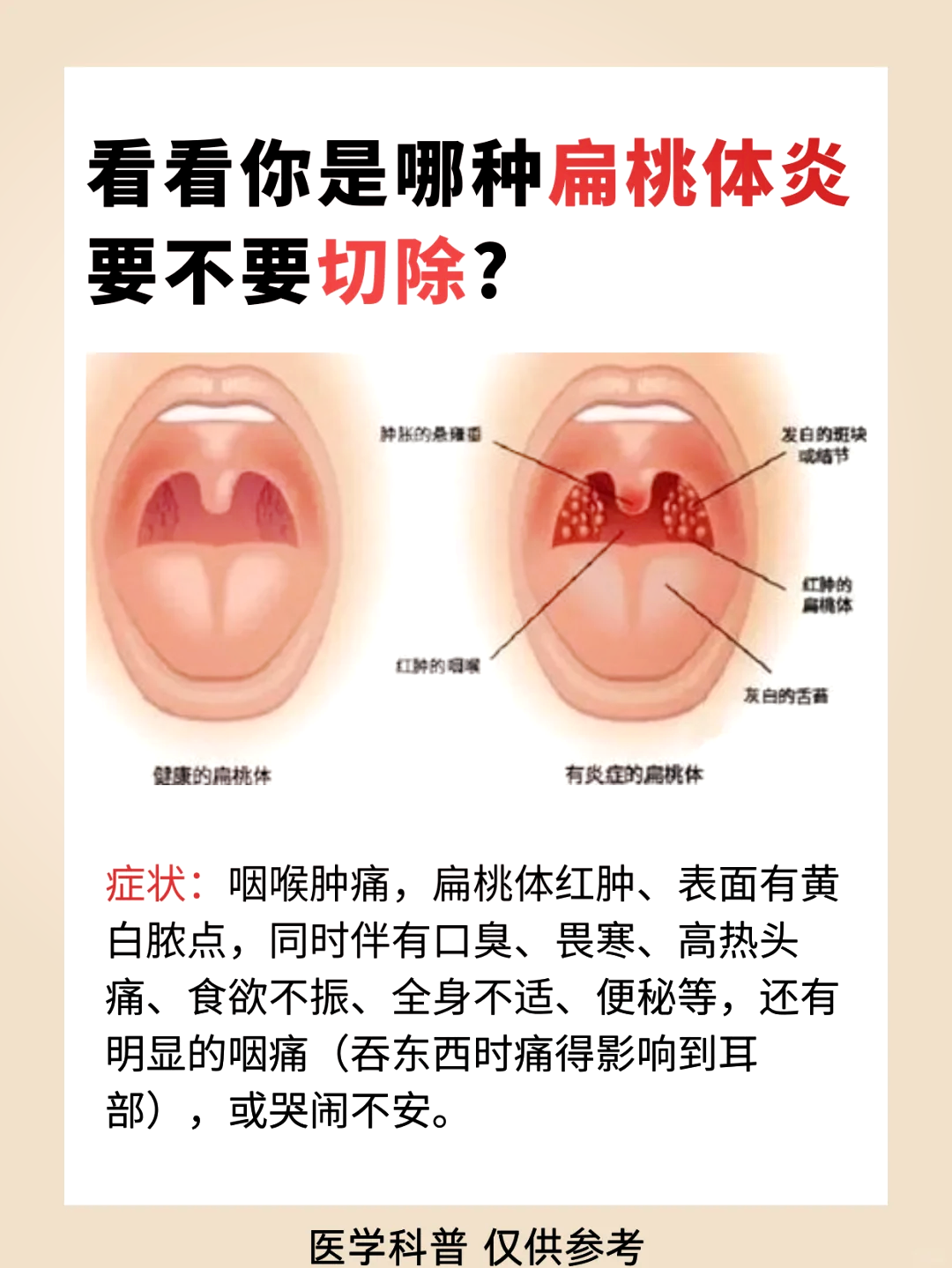 腭扁桃体有白色东西图片