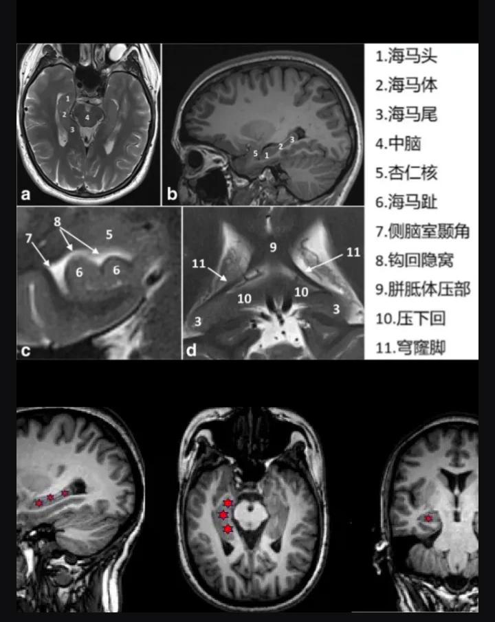 颞叶海马解剖图片图片