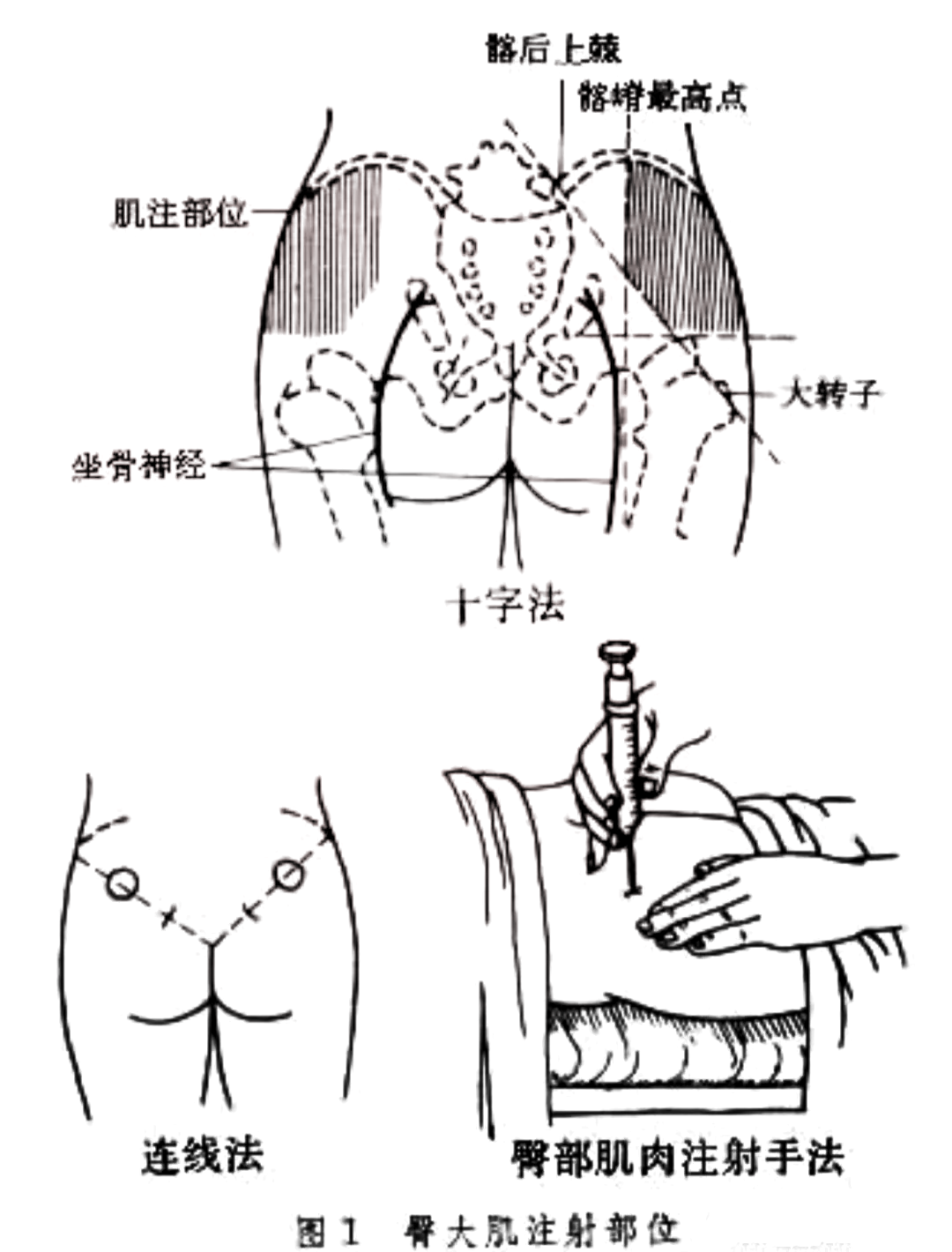 肌内注射连线法图片图片