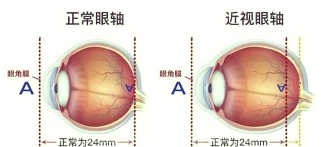 近视眼图片严重图片