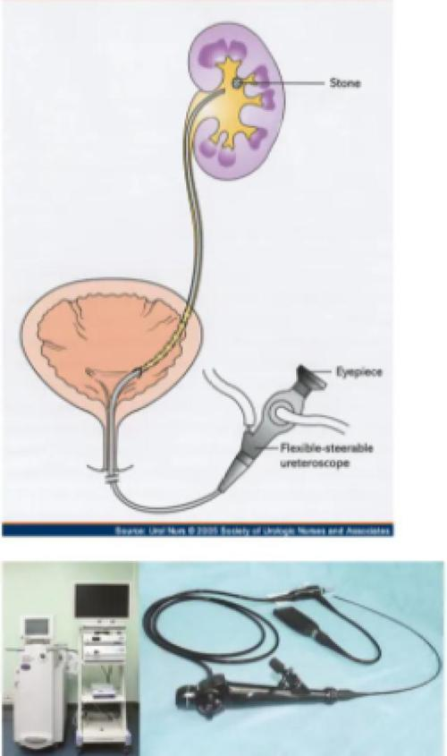 输尿管软镜取石术流程图片