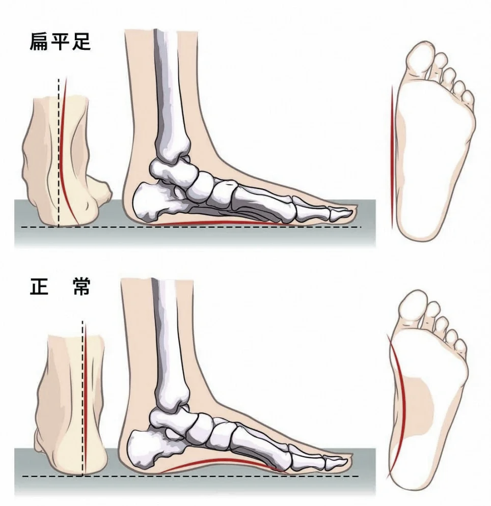 扁平足是怎样形成的图片