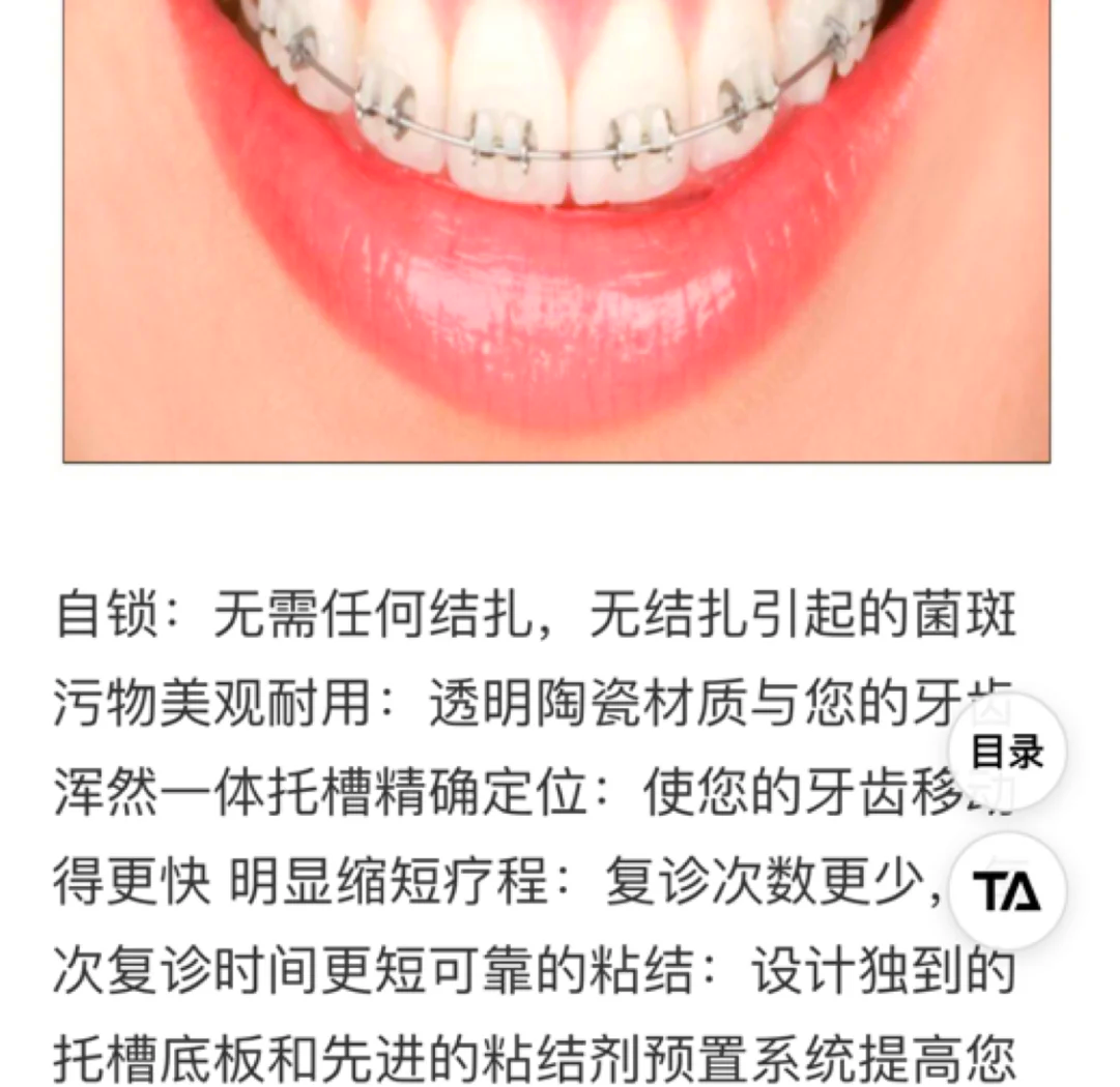 陶瓷牙套大概多少钱图片