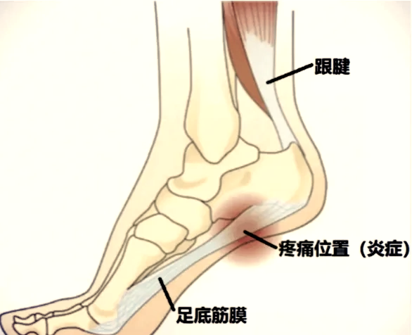 足底筋膜炎疼痛位置图图片