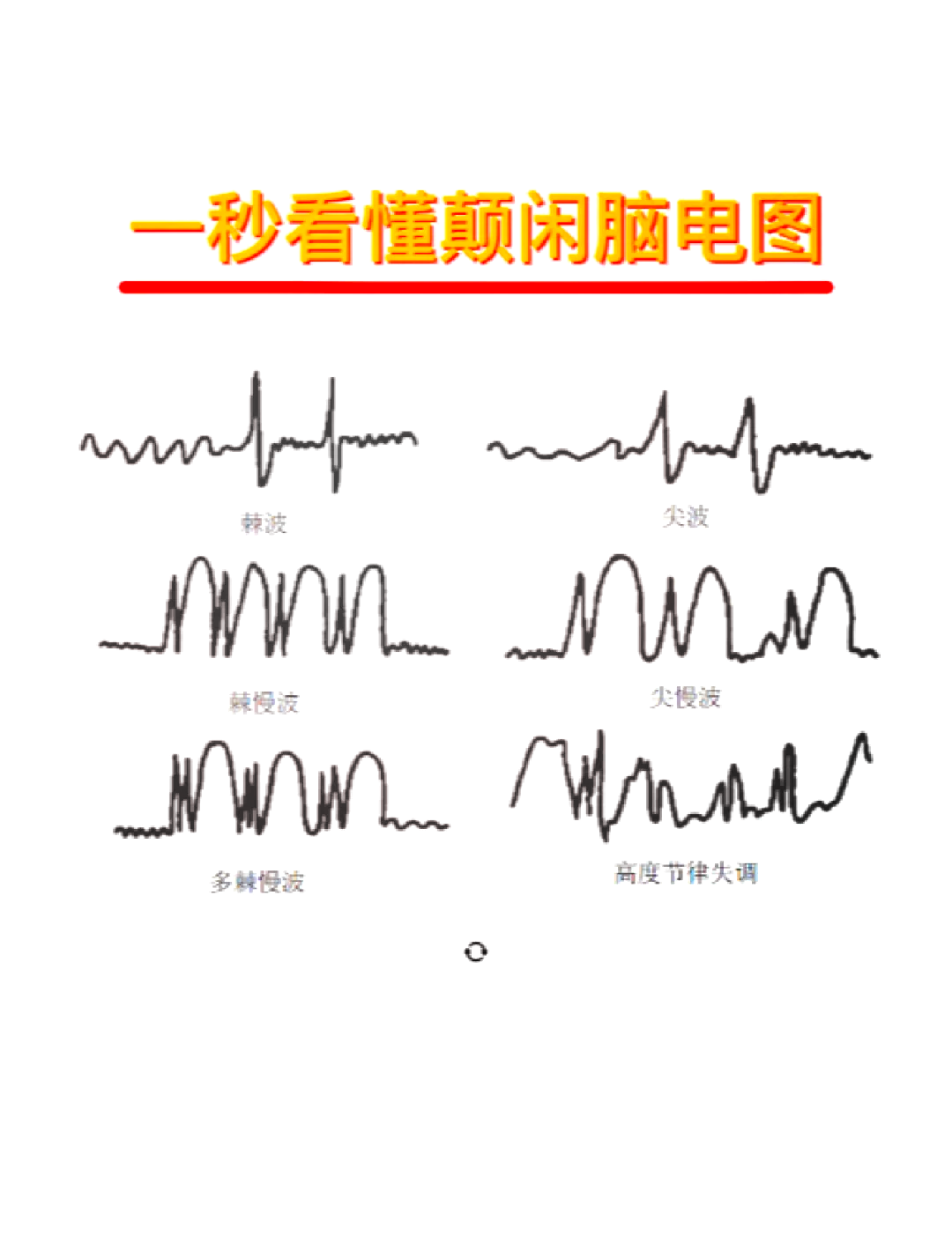 异常脑电图尖波尖慢波图片