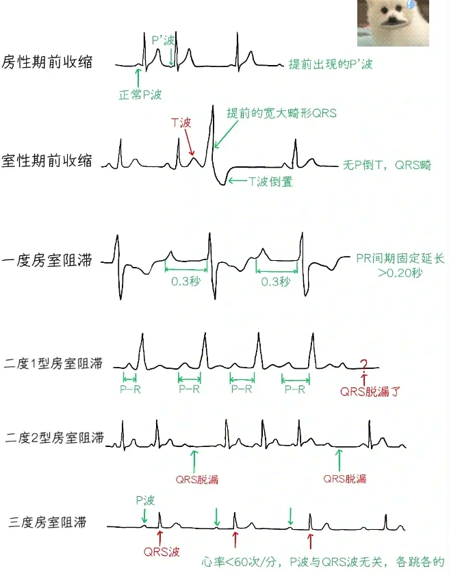 正常心室除极顺序图解图片